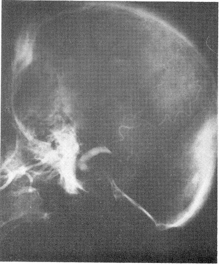  figure 3: Angiogram, lateral view: Note filling of the lumen of the aneurysmal sac, as well as the sharp cut in the upper part of the sac due to pressure of the hematoma